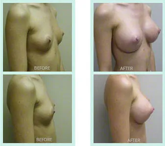 Breast Augmentation before and after set 5